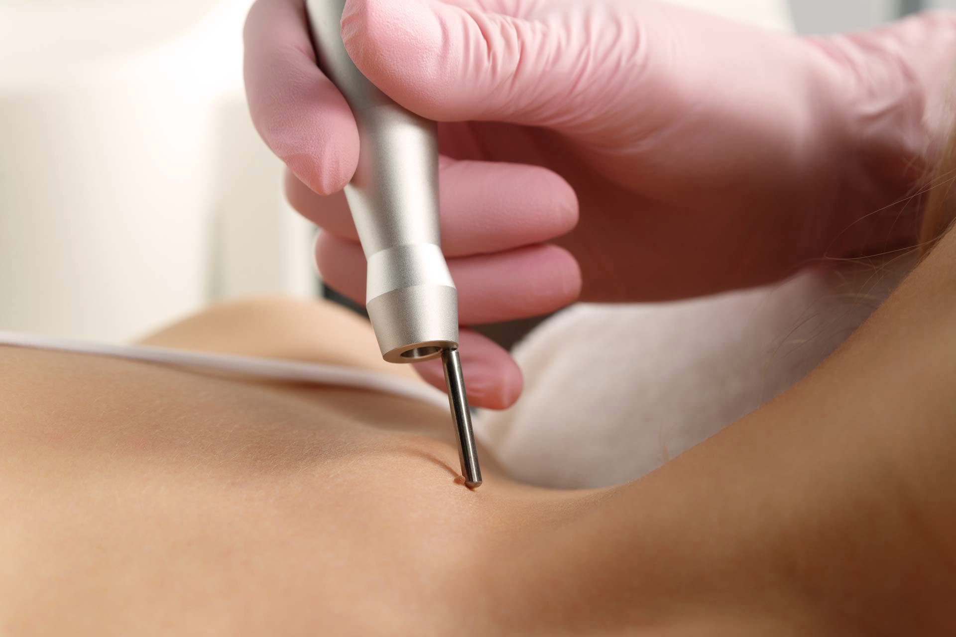 картинка Лазер Capello CO2  от магазина ЭпилСити